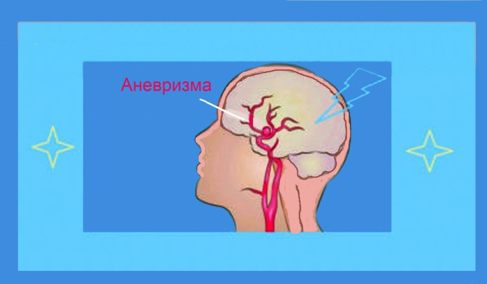 Что такое аневризма головного мозга фото