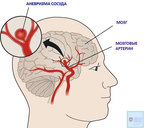 Лечение аневризмы головного мозга