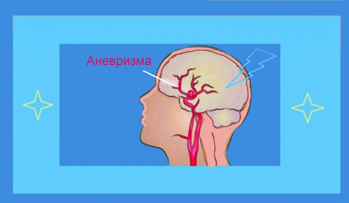 Что такое аневризма сосудов головного мозга