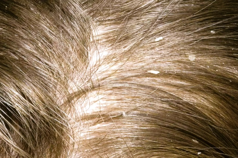 Себорейный дерматит на волосах