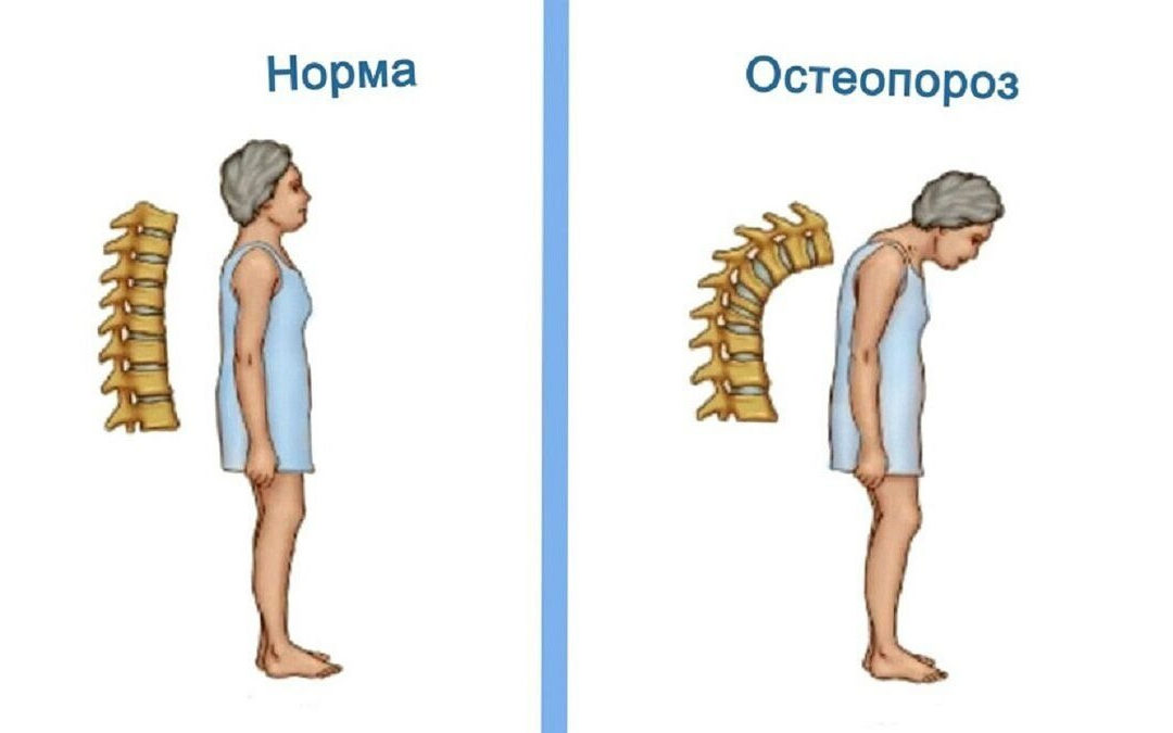 Лечение остеопороза