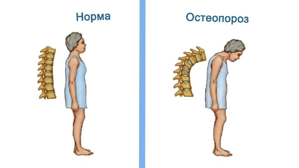 Лечение остеопороза