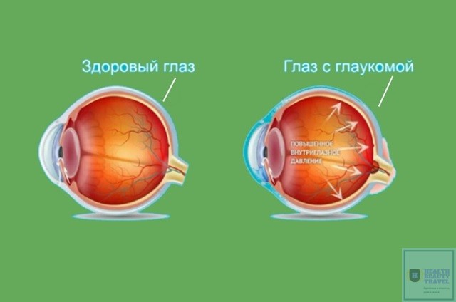 Причины возникновения глаукомы
